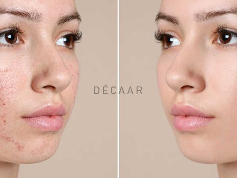Cải thiện mụn sau peel